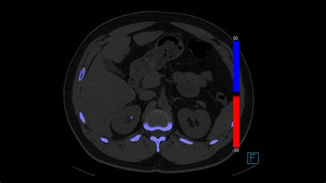 Kidney Stone Cat Scan
