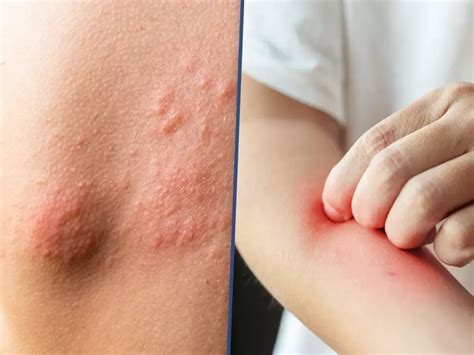 No risk of VTE in Eczema Patients Receiving JAK Inhibitors: Study