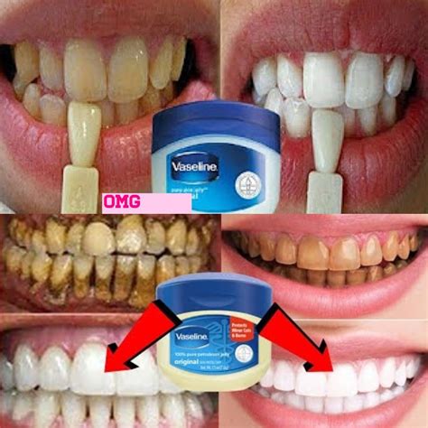 Make Your Smile Brighter the Natural Way: Using Vaseline to Whiten Your Teeth - Page 2 of 2 ...