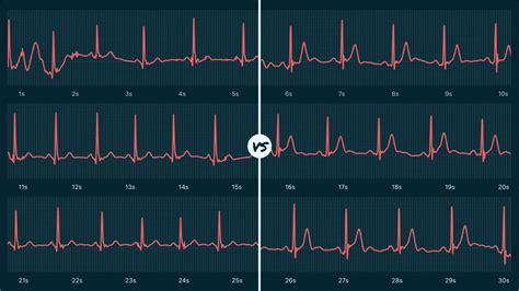 Sinus Rhythm Vs. Sinus Bradycardia on Your Watch ECG | Qaly