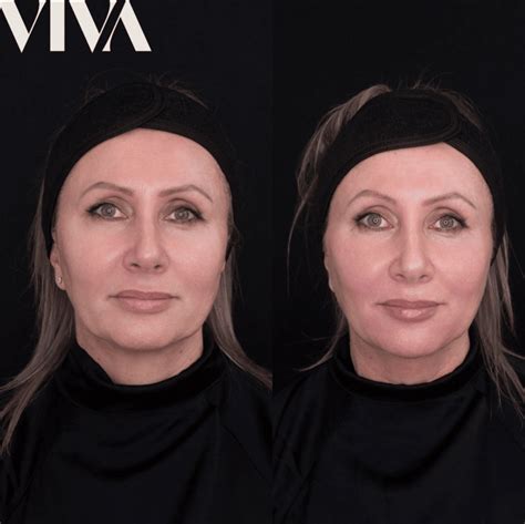 Fillers for jowls: Can cheek filler lift sagging jowls? - VIVA Skin Clinics