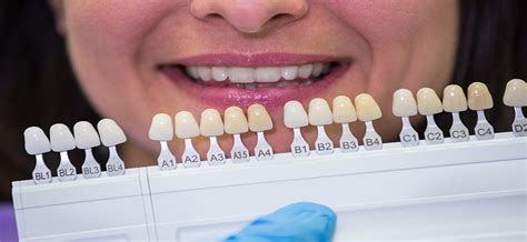 Dental Veneer Treatment in Chandigarh