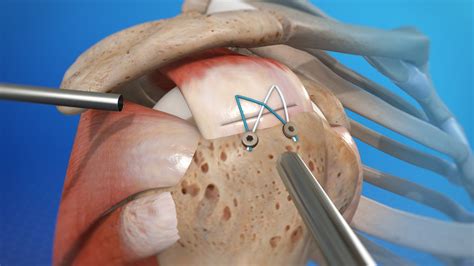 Shoulder Arthroscopy for Rotator Cuff Tears | Shoulder Keyhole Surgery