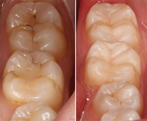 Tooth Restoration, Cavity Filling in tooth