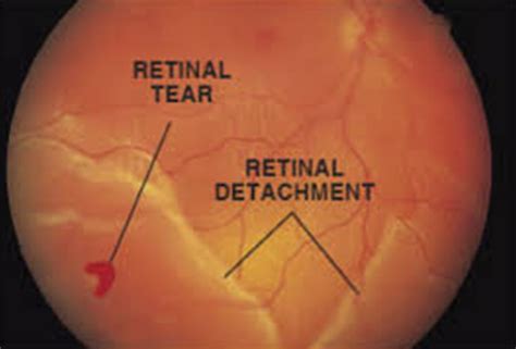Myopia Treatment in Thane | Dr. Pallavi Sarate