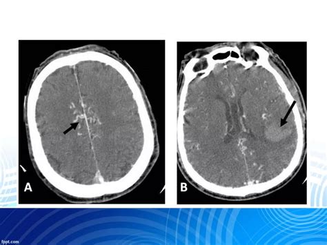 Dural arteriovenous fistula & AVM | PPTX