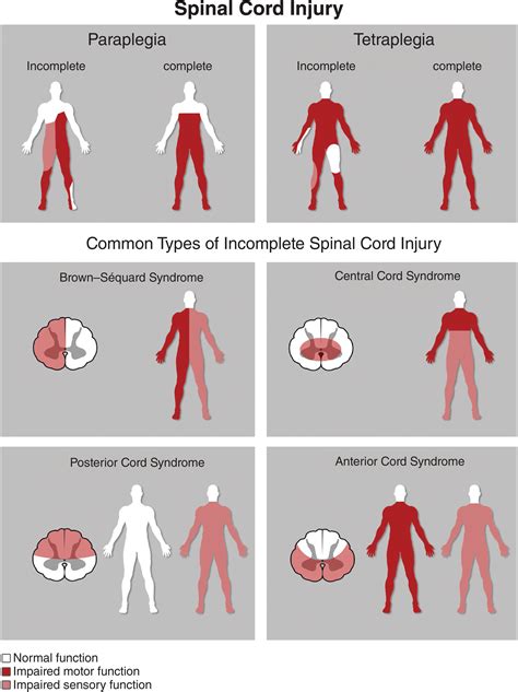 Types Of Spinal Cord Syndromes at Andre Mccann blog