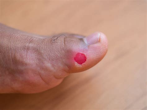 Watch Rashes: How to Prevent Irritation from the Watch Strap | SkinEasi ...