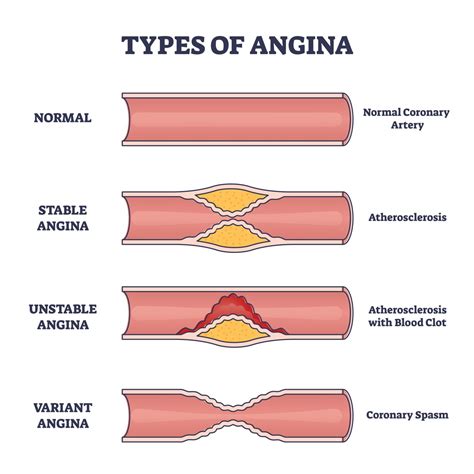 Angina Treatment, Signs & Causes | The Keyhole Heart Clinic