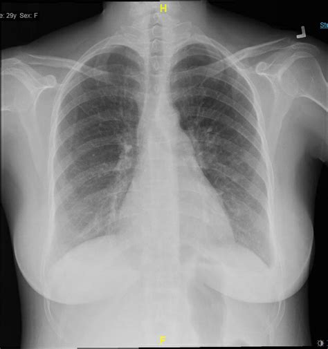 Does Chest X Ray Show Mucus at Marisa Johnson blog