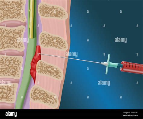Epidural Blood Patch Procedure, Illustration Stock Photo - Alamy