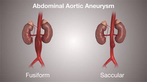 ABDOMINAL AORTIC ANEURYSM: Symptoms, Causes & Treatment - Scientific ...