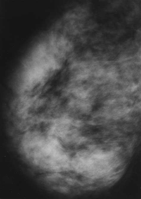 Herpes Simplex Virus Mastitis Clinical and Imaging Findings | AJR