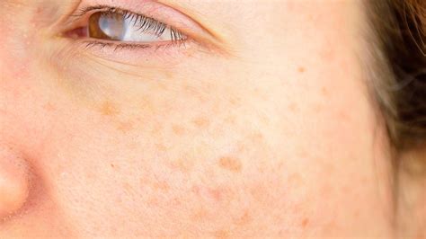 Age & Liver Spots: Symptoms, Causes, & Treatment - Toronto Dermatology ...