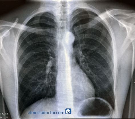 Image result for Normal X-ray