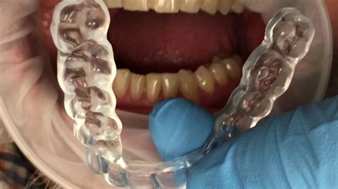Two Buccal Bites for Occlusal Guard Fabrication | CAD-Ray.com