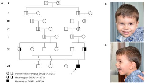 A Novel Homozygous GPAA1 Variant in a Patient with a ...