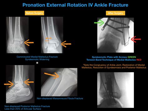 Medial Malleolar Fractures - Robert Sheinberg, DPM | Weston, FL Podiatrist