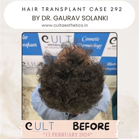 Hair Transplant Results 292 | Cult Aesthetics