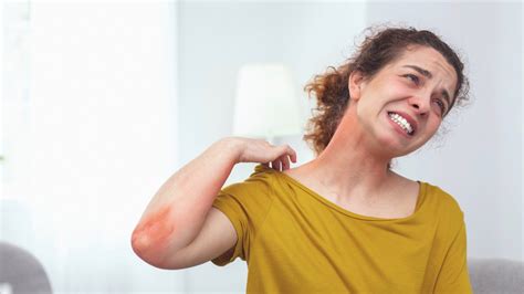 Why Does Sunburn Itch, Severe, Unbearable & Treatment of Itchy Sunburn - American Celiac