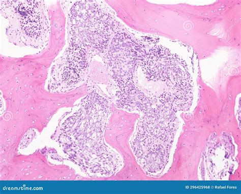 Metastasis of Prostate Cancer in Bone Marrow. Stock Photo - Image of clinical, medical: 296425968