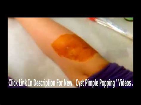 Image result for boils cysts abscesses exploding