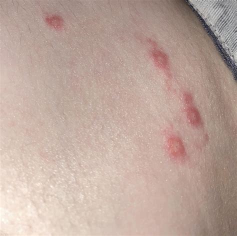 What are these bumps on my legs/thighs/hips? : r/DermatologyQuestions