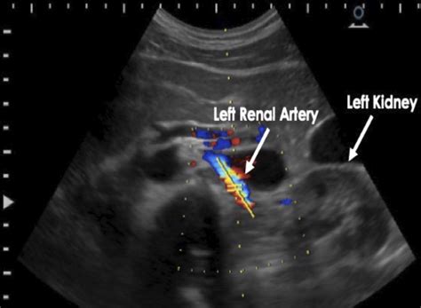 Renal Artery Ultrasound
