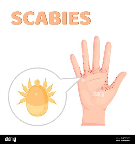 Scabies. contagious skin infestation. scabies mite and Human's skin ...