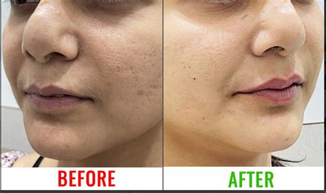 Best Dermal Fillers Treatment Clinic in Kolkata | Kaayakalp