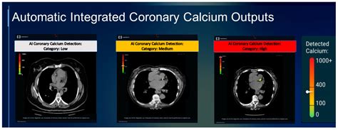 Artificial Intelligence in Coronary Artery Calcium Scoring Detection ...