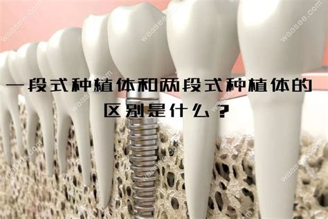解析二段式种植体的组成及埋入式和非埋入式区别,种牙必看 - 牙科治疗 - 开立特口腔