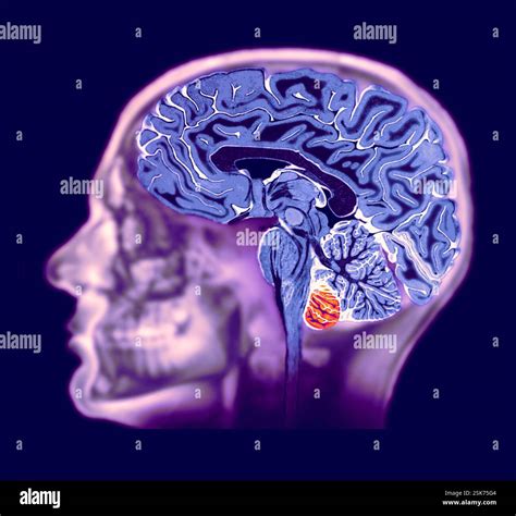Healthy brain. Coloured magnetic resonance imaging (MRI) scan of a healthy brain superimposed on ...
