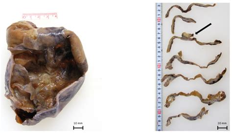 Genetic Profiling of Malignant Melanoma Arising from an Ovarian Mature ...