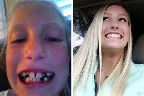 20 Antes e depois de pessoas que utilizaram aparelho dentário. O #3 é ...