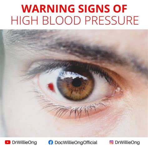 Can Eye Drops Affect Blood Pressure at Johnny Moe blog