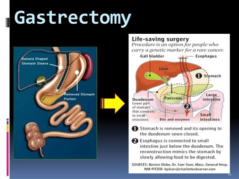 Image result for Colon Polyps Types