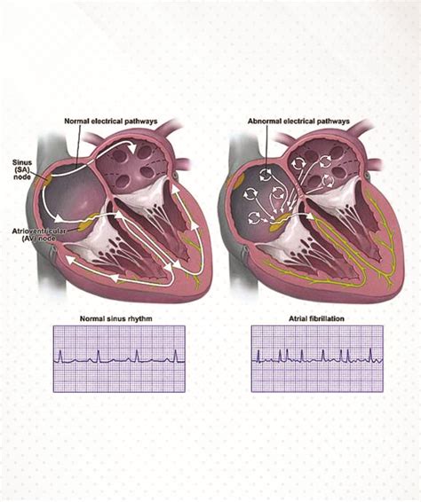 The Ultimate Treatment For Rhythm Disorder Now In Kerala | Metromed ...