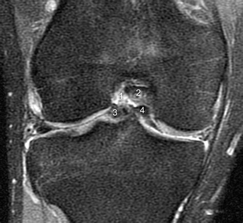Bucket-handle Tear of the Meniscus | Radsource