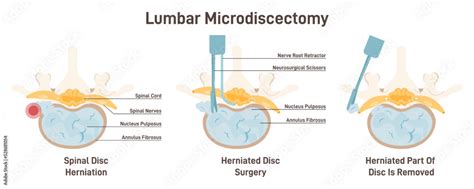 Bulging Disc Surgery 的图像结果