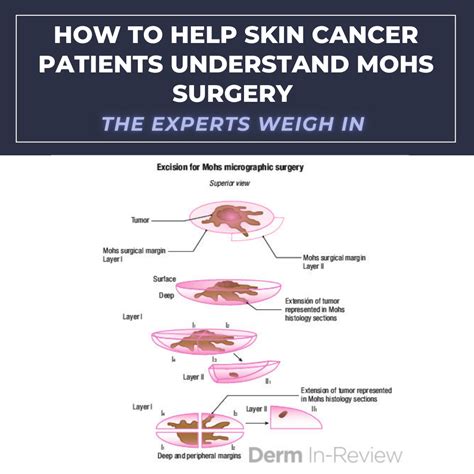 How to Help Skin Cancer Patients Understand Mohs Surgery | The Experts Weigh In - Next Steps in ...