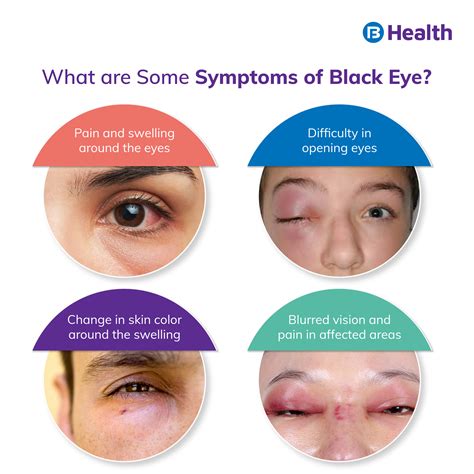 A Complete Guide on Black Eye: How to Know If You have It?