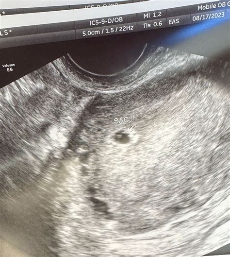 5 week ultrasound | BabyCenter