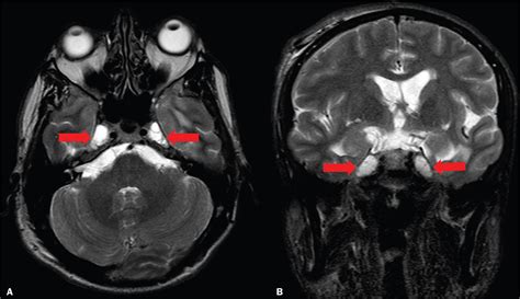 Intracranial Hypertension Quotes