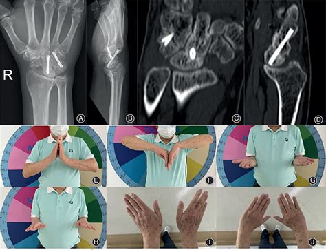 A Novel Technique of Arthroscopic‐Assisted Four‐Corner Fusion and Robot‐Assisted Fixation for ...