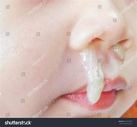 List 102+ Pictures What Does A Nasal Mucus Plug Look Like Stunning