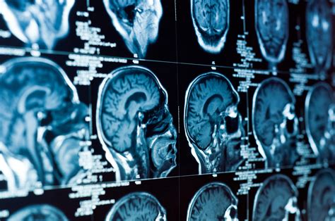 Legal Options For Victims Of Brain Injuries | Loshak Law PLLC