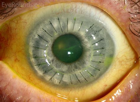 Cornea Transplant Video