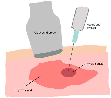 Thyroid Cancer Medical Procedure