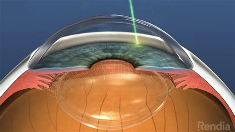 Glaucoma Laser Surgery